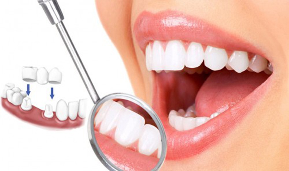 Kinh nghiệm, quy trình bọc răng sứ với 5 bước đơn giản
