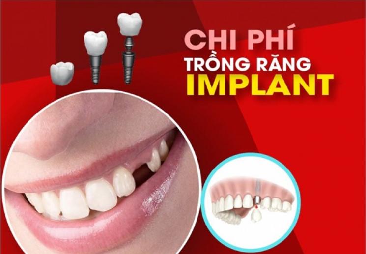 Tr Ng R Ng Implant Gi Bao Nhi U B Ng Gi Tr Ng R Ng Implant