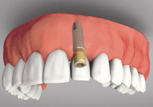 Trồng Implant Có Sử Dụng Được Vĩnh Viễn Không? Nha Khoa Quốc Tế Á Châu - ảnh 2