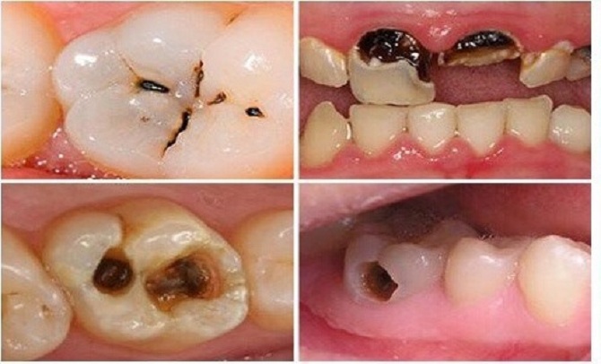 Bệnh Sâu Răng: Nguyên Nhân, Triệu Chứng Và Cách Điều Trị Hiệu Quả - ảnh 1