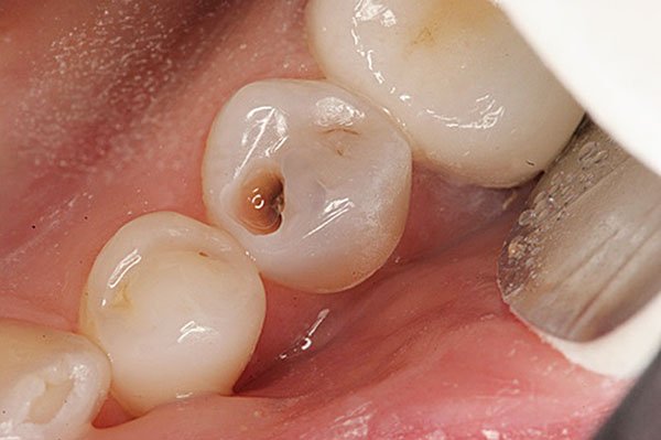 Răng Sâu Có Lỗ Thủng Phải Làm Sao? – Nha Khoa Quốc Tế Á Châu - ảnh 6