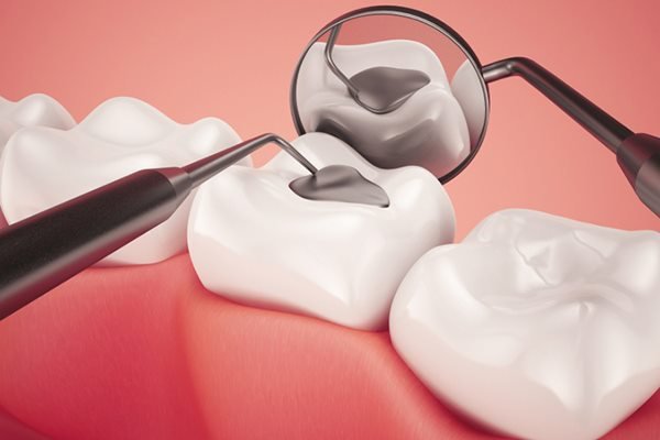 Bệnh Sâu Răng: Nguyên Nhân, Triệu Chứng Và Cách Điều Trị Hiệu Quả - ảnh 6