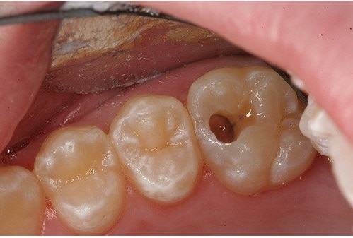 Răng Sâu Có Lỗ Thủng Phải Làm Sao? – Nha Khoa Quốc Tế Á Châu - ảnh 3