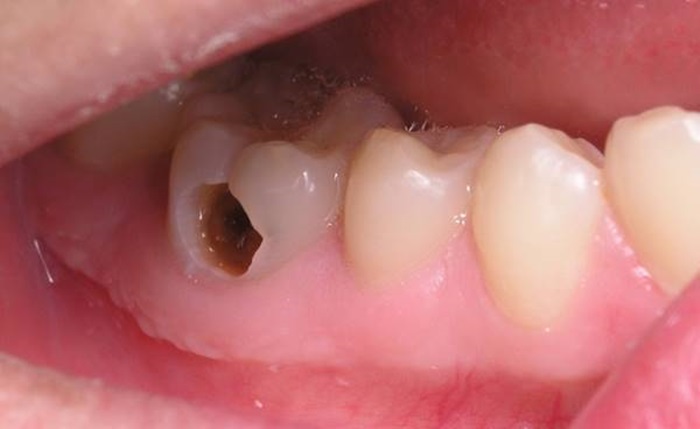 Răng Sâu Có Lỗ Thủng Phải Làm Sao? – Nha Khoa Quốc Tế Á Châu - ảnh 1