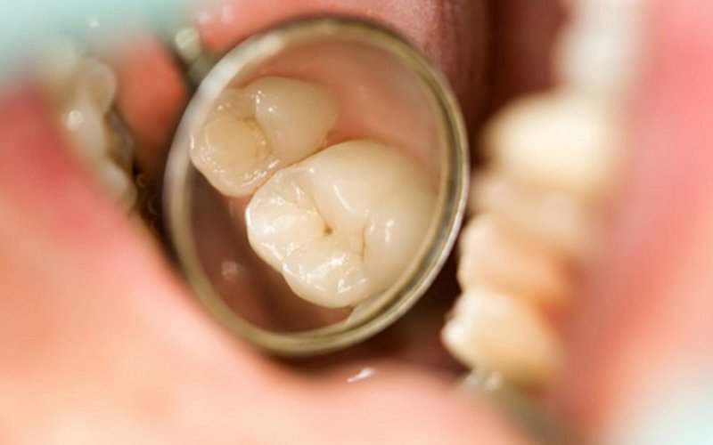 Răng Sâu Có Lỗ Thủng Phải Làm Sao? – Nha Khoa Quốc Tế Á Châu - ảnh 2