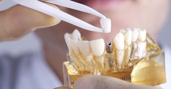 Trồng Răng Implant Thất Bại: Nguyên Nhân Và Cách Phòng Tránh - ảnh 4