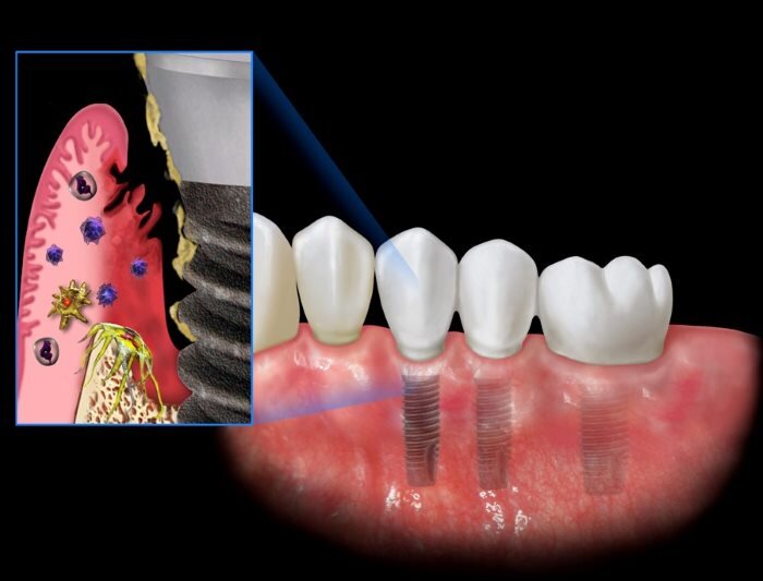 Trồng Răng Implant Thất Bại: Nguyên Nhân Và Cách Phòng Tránh - ảnh 5