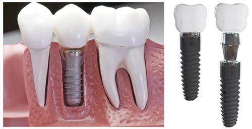 Làm Răng Implant Bao Lâu Thì Hỏng? – Nha Khoa Quốc Tế Á Châu - ảnh 4