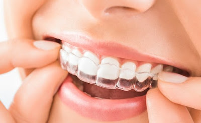 Những điều cần biết về niềng răng không mắc cài Invisalign - ảnh 1