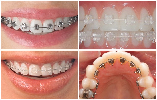 So sánh ưu và nhược điểm các phương pháp niềng răng mắc cài - ảnh 1