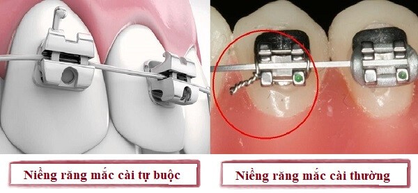 So sánh ưu và nhược điểm các phương pháp niềng răng mắc cài - ảnh 2