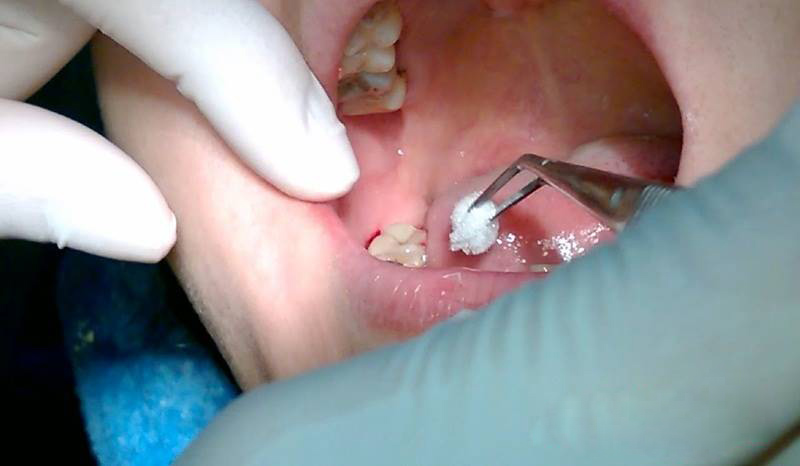 Nhổ răng khôn bị nhiễm trùng