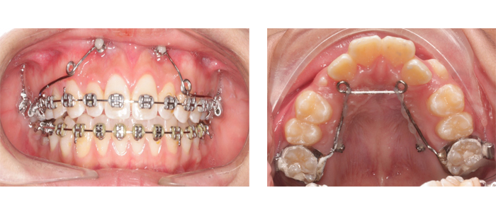 So sánh ưu và nhược điểm các phương pháp niềng răng mắc cài - ảnh 3