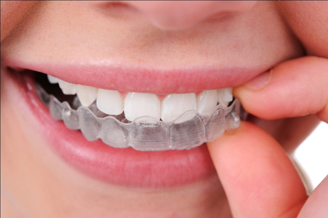 Những điều cần biết về niềng răng không mắc cài Invisalign - ảnh 3