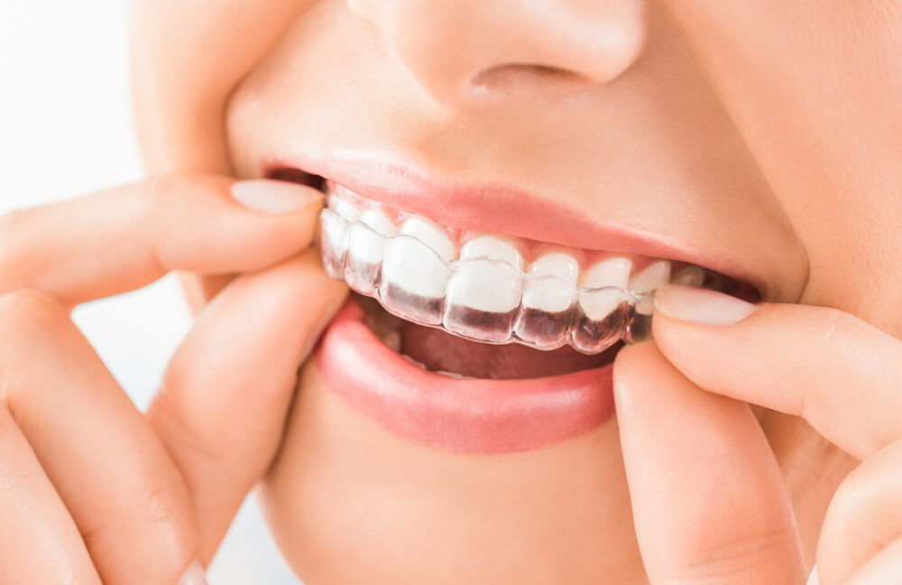 Những điều cần biết về niềng răng không mắc cài Invisalign - ảnh 4