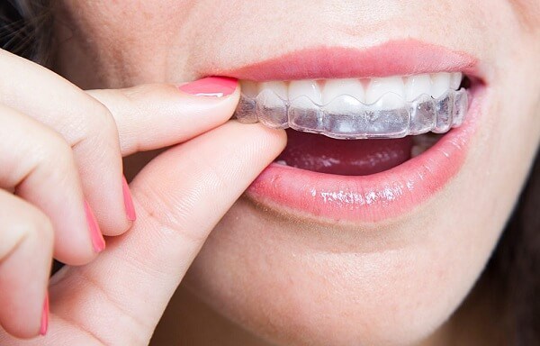 Niềng răng trong suốt là gì? Những điều cần biết trước khi làm