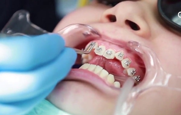 Implant là gì   dịch vụ tốt nhất