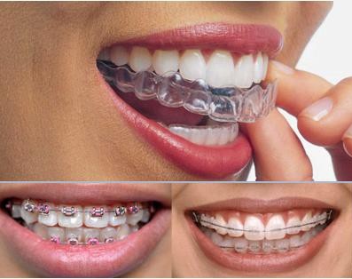 Nên lựa chọn phương pháp niềng răng nào sau khi bọc răng sứ