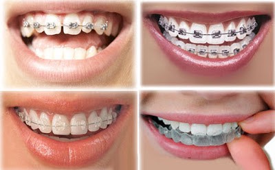 Cách phòng ngừa răng thưa là gì?
