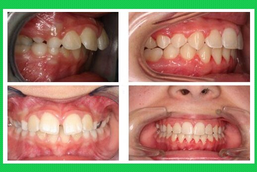 Những Điều Cần Biết Về Răng Hô Và Phương Pháp Chữa Răng Hô - ảnh 4