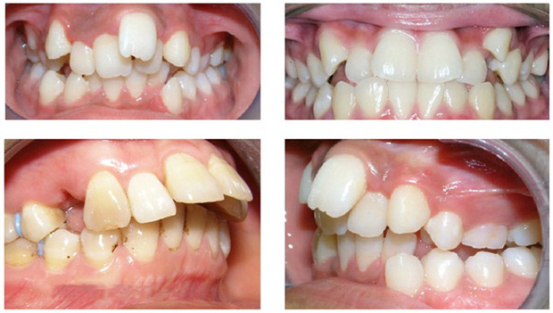 Những Điều Cần Biết Về Răng Hô Và Phương Pháp Chữa Răng Hô - ảnh 2