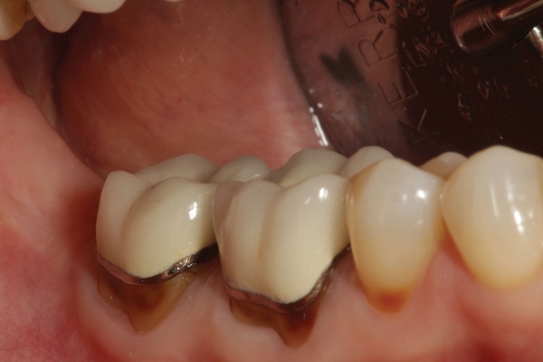 Bọc Răng Sứ Bị Hở Chân Răng – Cách Khắc Phục Hiệu Quả Nhất - ảnh 3