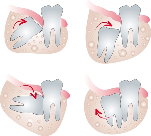 Nhổ Răng Khôn Hàm Trên Và Những Điều Quan Trọng Cần Biết - ảnh 3