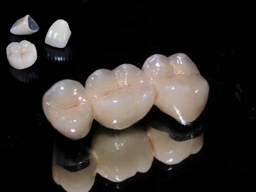 Bọc sứ răng khểnh có những ưu điểm gì?