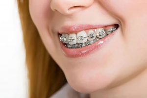 Răng hô, nguyên nhân và những thông tin cần biết về niềng răng hô