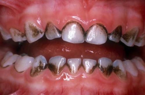 Răng đen: Một số người cho rằng răng đen không đẹp, nhưng thực tế đây là một trào lưu mới rất hot trong giới trẻ hiện nay. Hãy xem hình ảnh và khám phá vẻ đẹp độc đáo của răng đen.