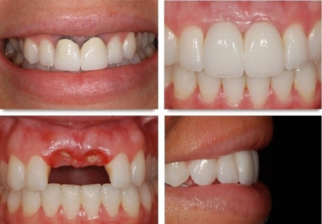 Trồng răng cửa: Việc trồng răng cửa sẽ giúp bạn có hàm răng đều và hỗ trợ tốt hơn cho chức năng nhai. Bạn sẽ không còn phải e ngại mỗi khi cười hoặc nói chuyện vì sự xuất hiện của khoảng trống, hàm răng không đều.