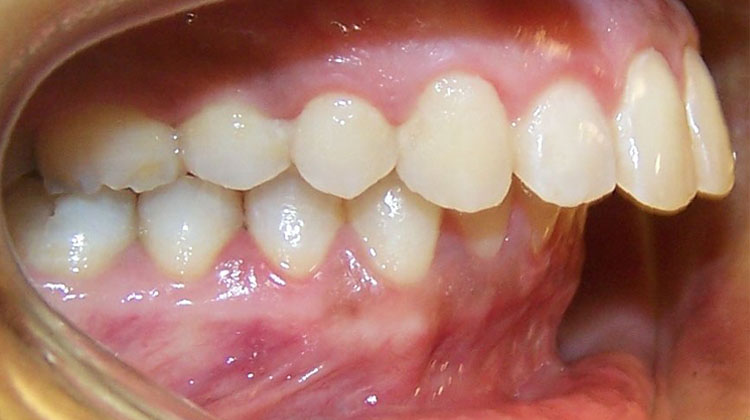 Răng hô, nguyên nhân và những thông tin hữu ích về niềng răng hô bạn cần biết!