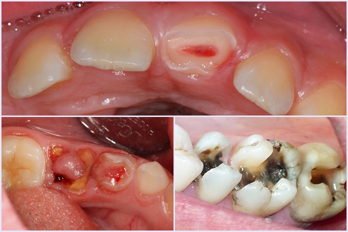 Nhổ răng sâu có ảnh hưởng đến sức khỏe nhiều không?
