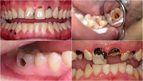 Sâu Răng Là Gì? Cách Chữa Trị Sâu Răng Hiệu Quả Nhất - ảnh 1