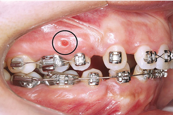 Tổng Hợp Các Cách Chữa Răng Thưa Hiệu Quả Nhất Hiện Nay - ảnh 3