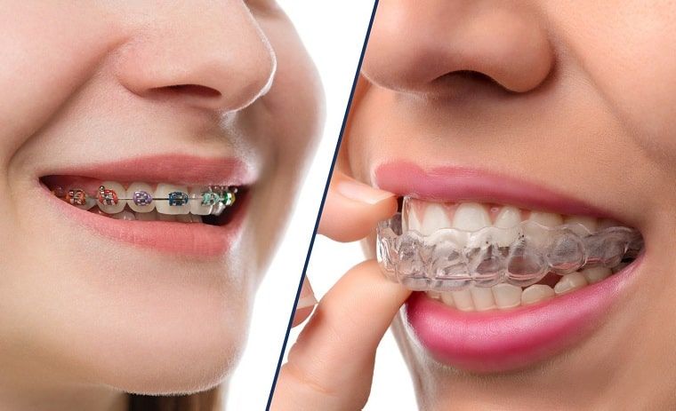 Niềng Răng Có Làm Răng Yếu Đi Không? Biểu Hiện Bình Thường Khi Niềng Răng