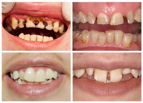 Nguyên nhân của răng xấu thường là do chăm sóc răng miệng không đúng cách hoặc là do gen di truyền. Tuy nhiên, đừng lo lắng vì Nha Khoa Thiên Đức có những giải pháp tốt để khắc phục tình trạng răng xấu của bạn. Bạn sẽ thấy sự khác biệt ngay sau khi trải qua quy trình chữa trị tại đây.