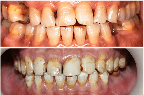 Răng xấu – Nguyên nhân và các cách khắc phục hiệu quả nhất - ảnh 2