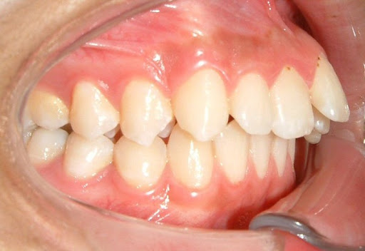 Răng xấu – Nguyên nhân và các cách khắc phục hiệu quả nhất - ảnh 3