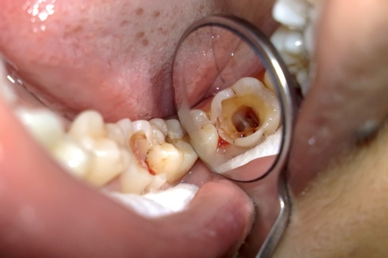 đau răng hàm trong cùng