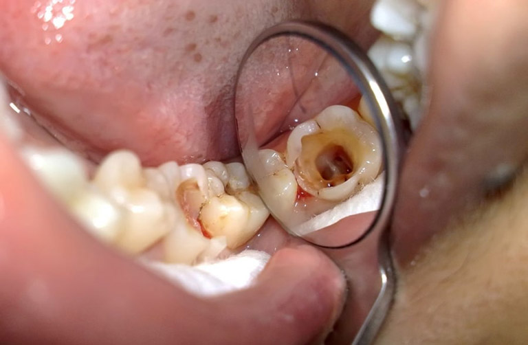 Răng Sâu Vào Tủy Là Gì – Răng Sâu Vào Tủy Có Nên Nhổ Răng Không? - ảnh 1