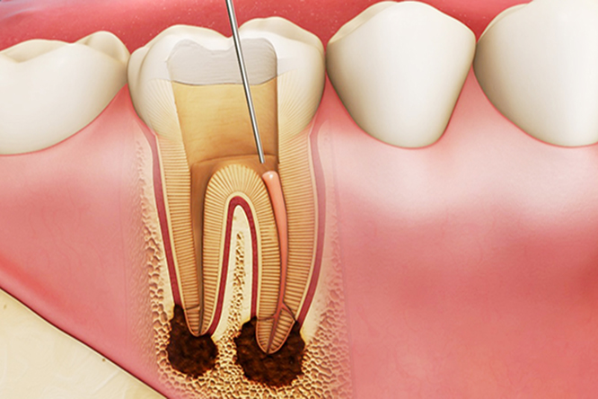 Lấy Tủy Răng Có Đau Không? Quy Trình Điều Trị Tủy Răng Như Thế Nào? - ảnh 1