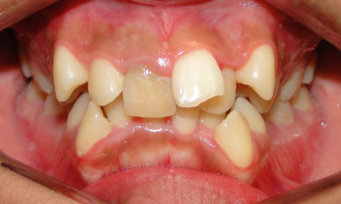 Răng Mọc Không Đều - Phương Pháp Điều Trị Nào Hiệu Quả Nhất?- ảnh 1