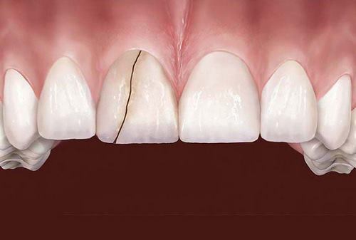 Răng sứ kém chất lượng sẽ dễ dàng bị gãy và mẻ khi ăn uống nhai 