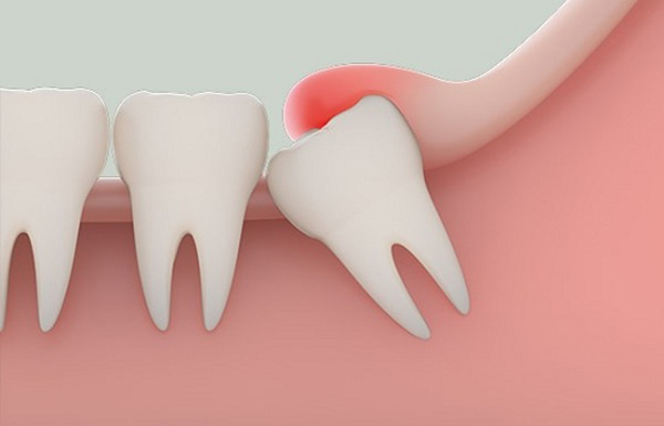 Cắt Lợi Trùm Răng Khôn Là Gì? Cách Nhận Biết Và Điều Trị Hiệu Quả - ảnh 1