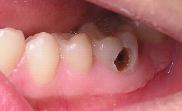 Răng Sâu Vào Tủy Là Gì – Răng Sâu Vào Tủy Có Nên Nhổ Răng Không? - ảnh 2