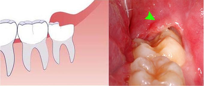 Cắt Lợi Trùm Răng Khôn Là Gì? Cách Nhận Biết Và Điều Trị Hiệu Quả - ảnh 2