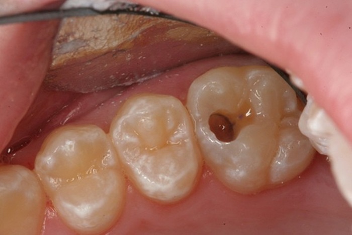 Răng Sâu Vào Tủy Là Gì – Răng Sâu Vào Tủy Có Nên Nhổ Răng Không? - ảnh 3