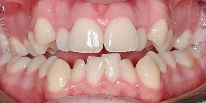 Răng Mọc Không Đều - Phương Pháp Điều Trị Nào Hiệu Quả Nhất?- ảnh 3