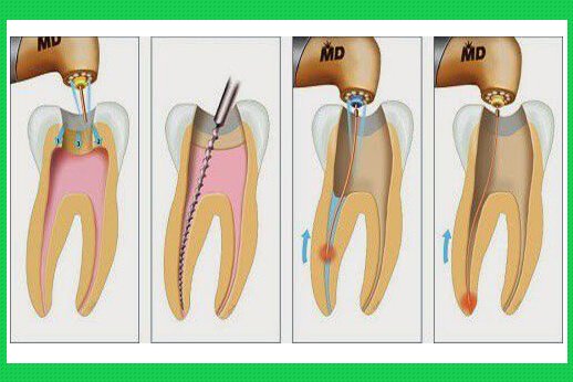 Có Nên Lấy Tủy Răng Để Bọc Sứ Không? Những Lưu Ý Quan Trọng Cần Biết - ảnh 4